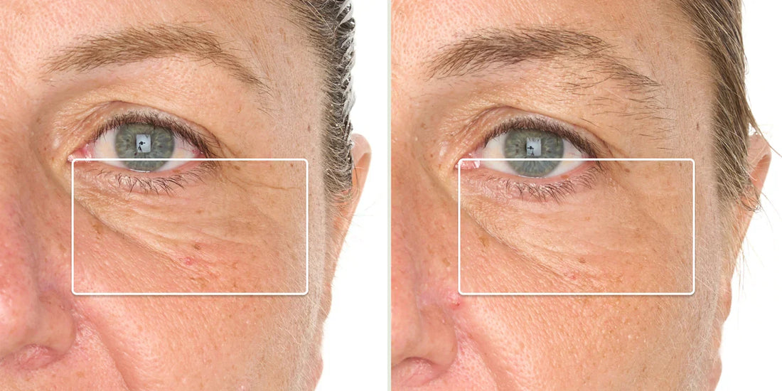 Before and after results of red LED light